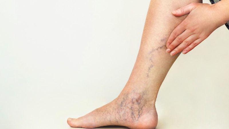 Varicose And Spider Veins Are Problems No Longer With Modern Treatments