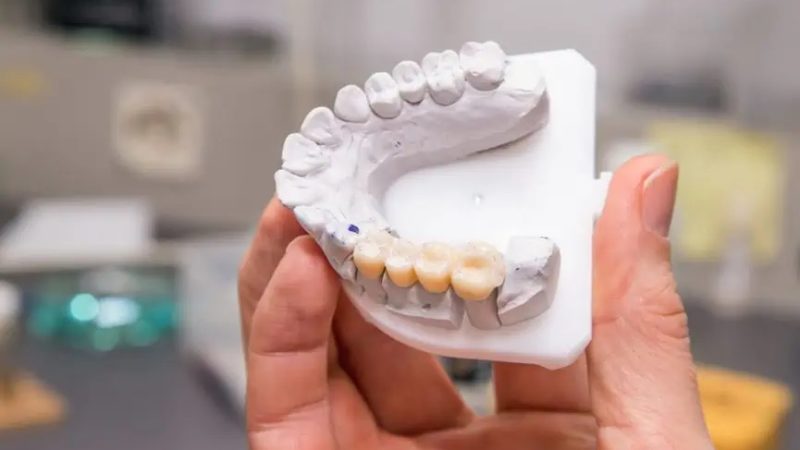 A Guide to Understanding Dental Bridges