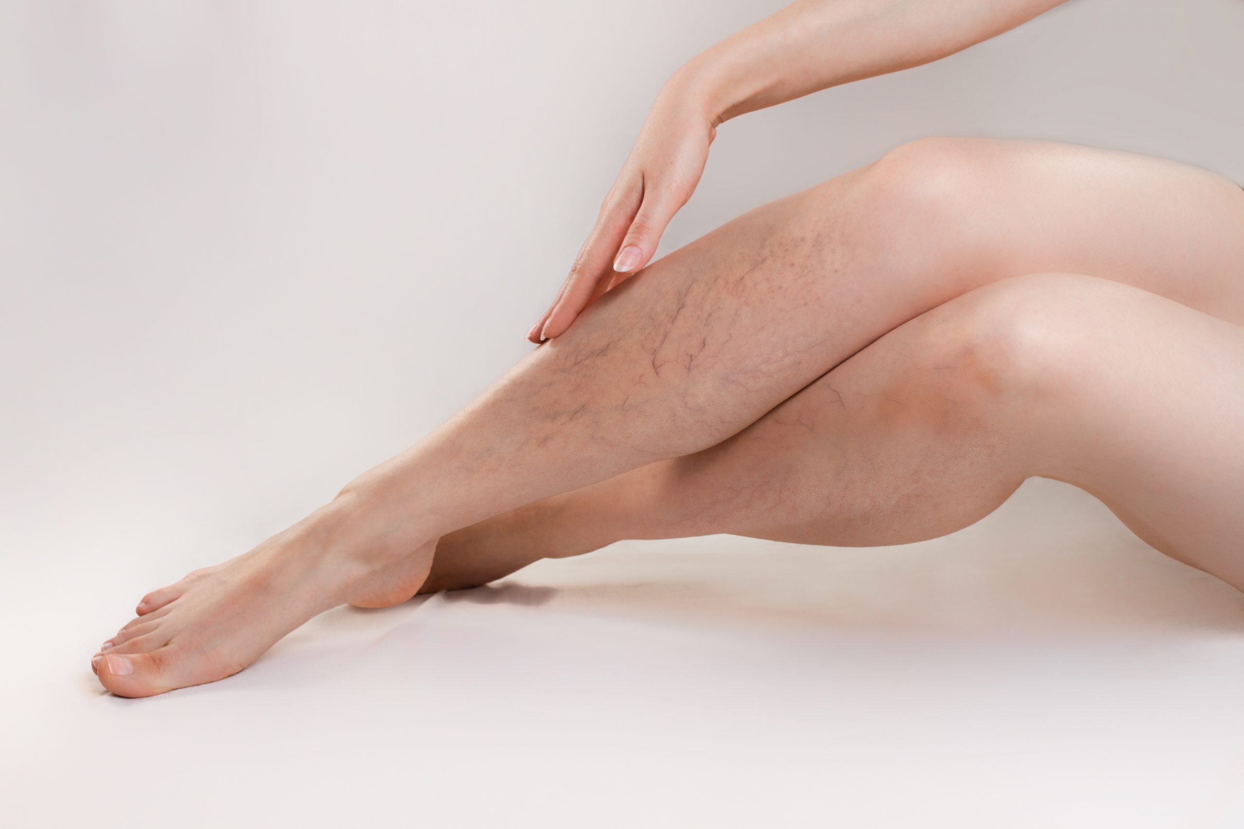 4 Common Treatments for Spider Veins You Need to Understand