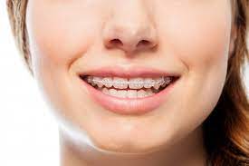The Benefits of Adult Braces