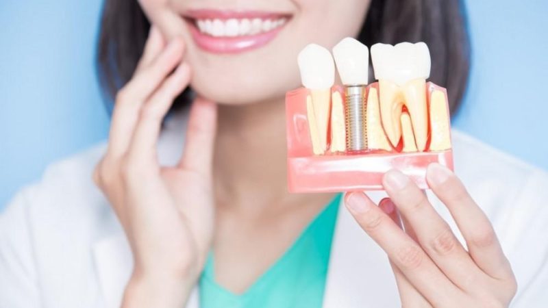 5 Major Benefits of Dental Implants