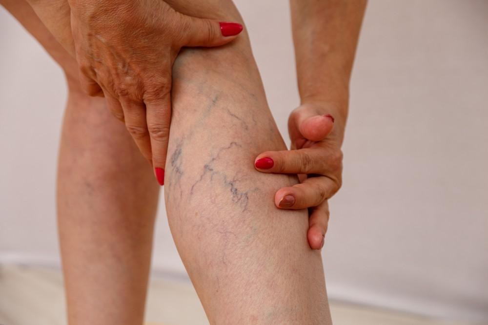 Curb the Appearance of the Unsightly Veins on Your Legs with Varithena