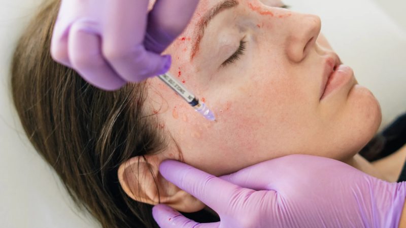 Tops Reasons Why People Choose Microneedling and PRP Treatments