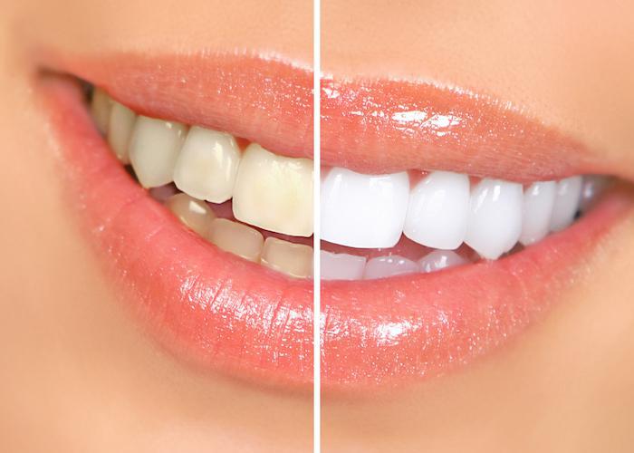 How to Maintain Results after Teeth Whitening