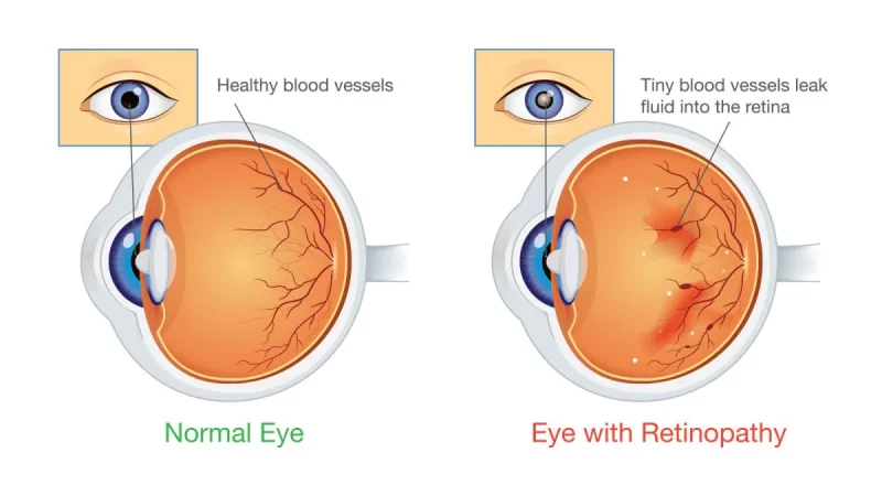 Myths Associated With Diabetes-Related Eye Problems