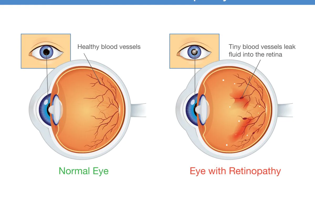 Myths Associated With Diabetes-Related Eye Problems