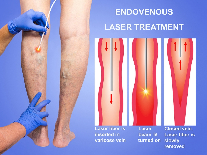 Do You Qualify For Sclerotherapy?