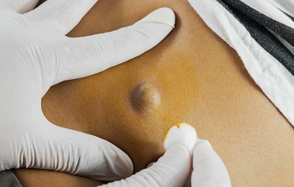 What to Expect After Cyst Removal