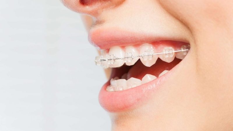 The Best Teeth Straightening Option To Consider
