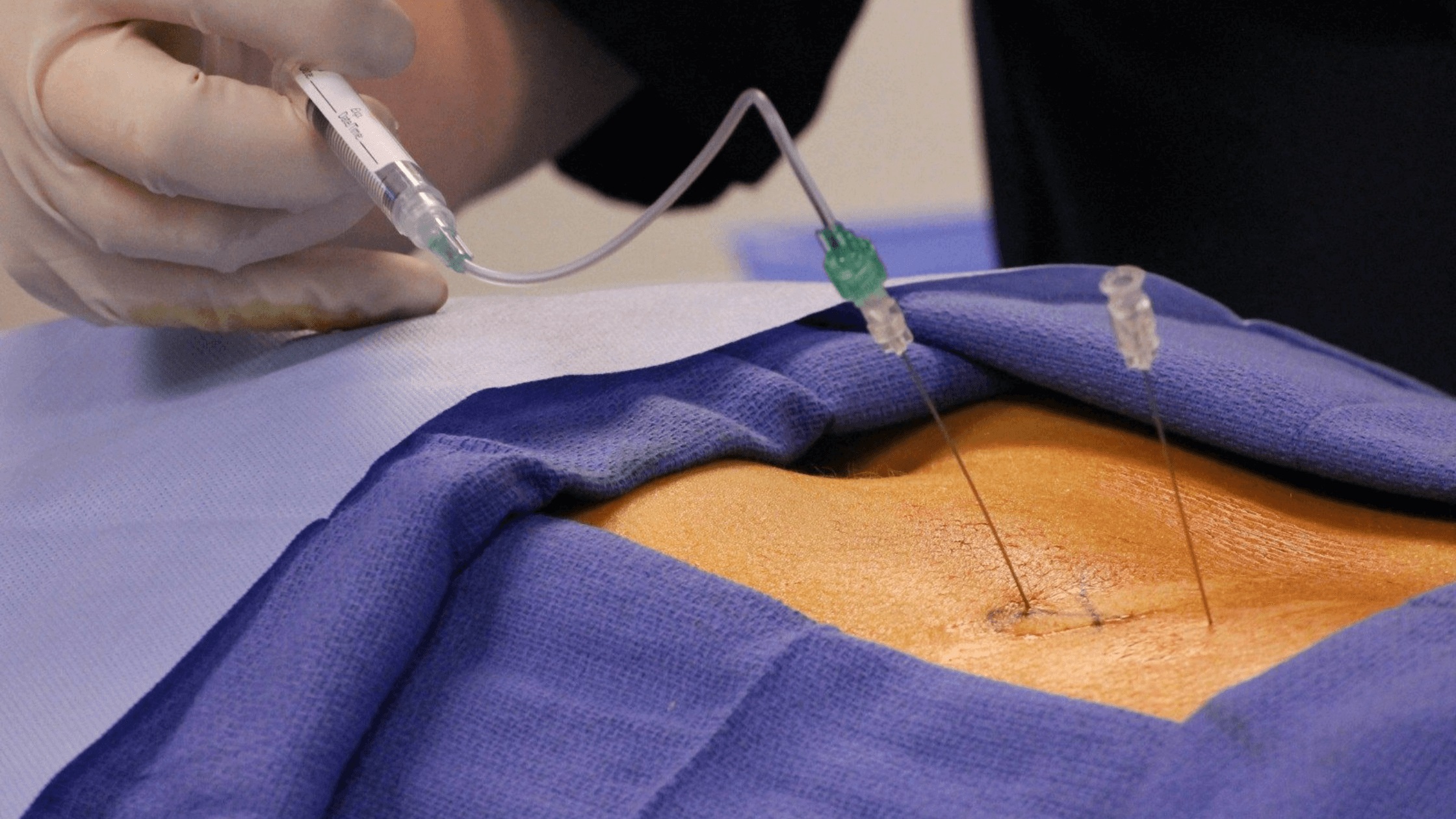 Understanding The Complex Nature of Epidural Steroid Injections