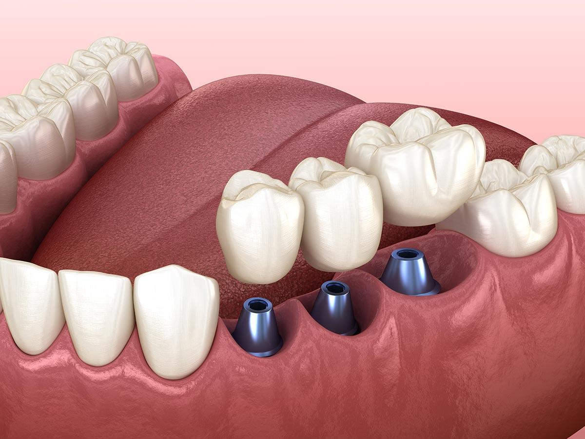 Worthy Benefits of a Tooth Implant Surgery