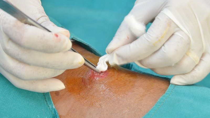 Why Incision and Drainage Kits Are Essential in Minor Surgical Procedures